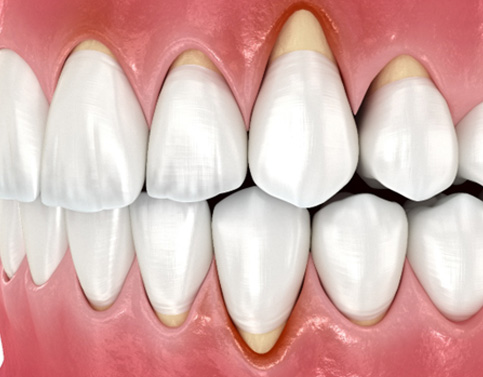 Illustration of gum recession