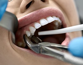 There are several important factors that could affect your tooth extraction cost, including the location of the tooth within your mouth