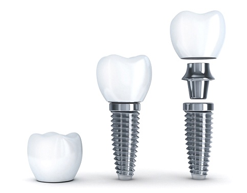 Diagram highlighting how dental implants work in Edison