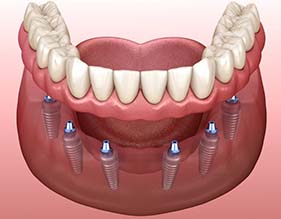 six dental implants supporting a denture