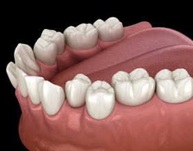 Illustration of crowded teeth