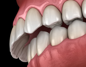 Illustration of teeth with overbite