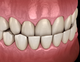 Illustration of teeth with underbite