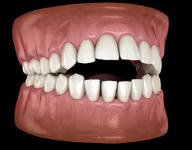 Illustration of teeth with open bite