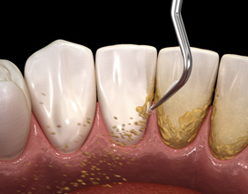 Scaling and root planing is done in two appointments